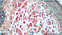 amyloidosis-nodular amyloidosis