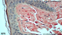 amyloidosis-nodular amyloidosis