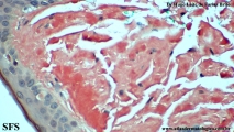 amyloidosis-nodular amyloidosis