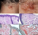 amyloidosis-nodular amyloidosis