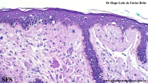 amyloidosis-nodular amyloidosis