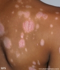 psoriasis