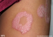 psoriasis