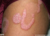 psoriasis