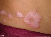 psoriasis