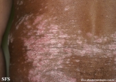 psoriasis