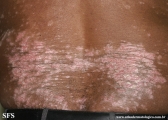 psoriasis