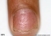 psoriasis