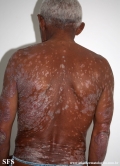 psoriasis