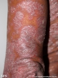 psoriasis