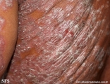 psoriasis