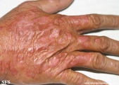 psoriasis