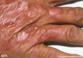 psoriasis