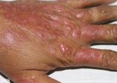 psoriasis