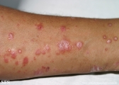 psoriasis