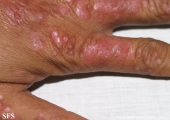 psoriasis