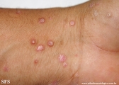 psoriasis