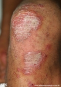 psoriasis