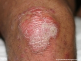 psoriasis