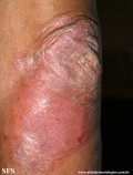 psoriasis