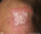 psoriasis