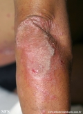 psoriasis