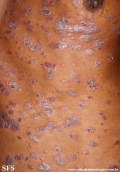 psoriasis