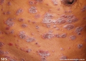 psoriasis