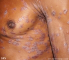 psoriasis