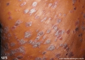 psoriasis