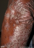 psoriasis