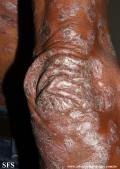 psoriasis