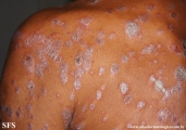 psoriasis