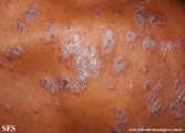 psoriasis