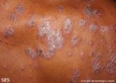 psoriasis