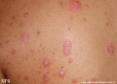 psoriasis