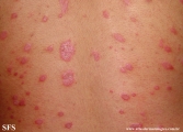 psoriasis