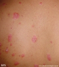 psoriasis