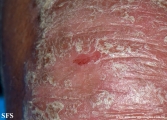 psoriasis