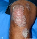 psoriasis