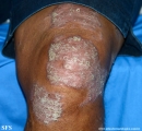 psoriasis