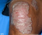 psoriasis