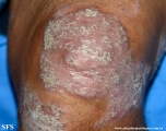 psoriasis