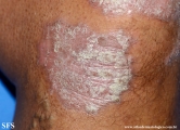 psoriasis