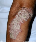 psoriasis