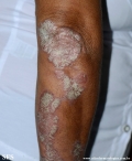 psoriasis