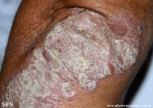 psoriasis