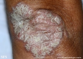 psoriasis