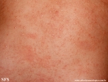 miliaria