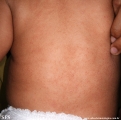 miliaria